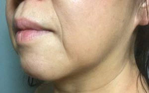 アンチエイジングの基礎知識！ほうれい線のしわを目立たなくする方法！